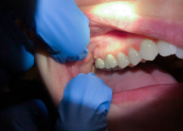 Best Emergency Treatment for Dental Infections or Abscesses in Cornelia, GA
