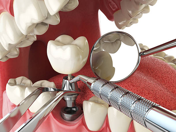 Best Emergency Wisdom Teeth Removal in Cornelia, GA